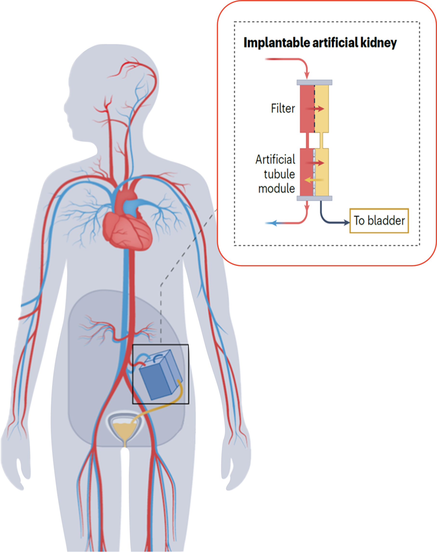 Schematisch diagram van de implanteerbare kunstnier